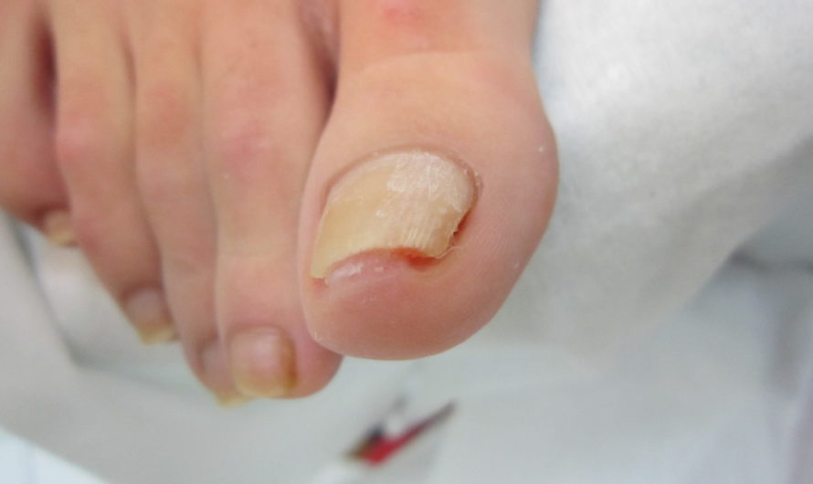 Вросший ноготь лечение