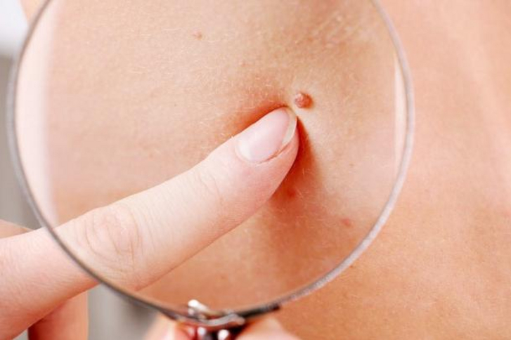 Папилломы у женщин