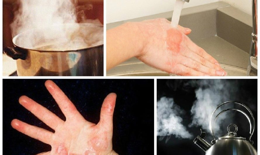 Сонник Обжечься