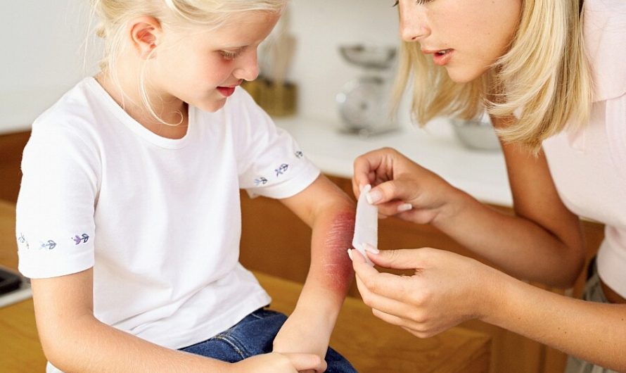 Лечение ожогов у детей