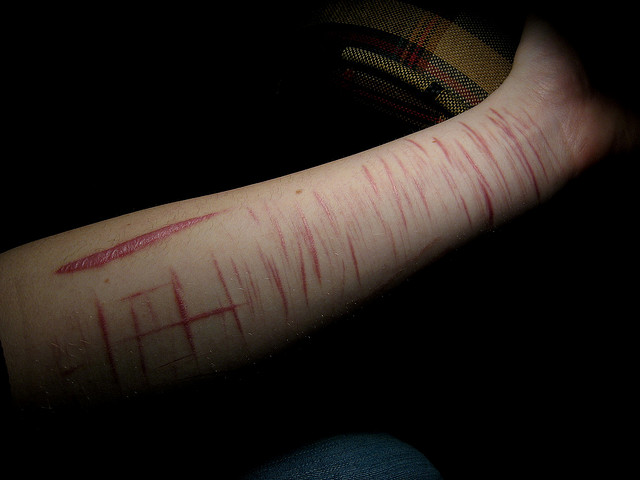 Порезы на левой руке