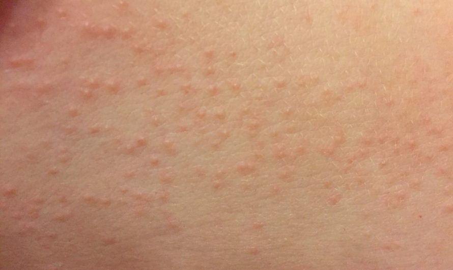 Сонник Сыпь во сне