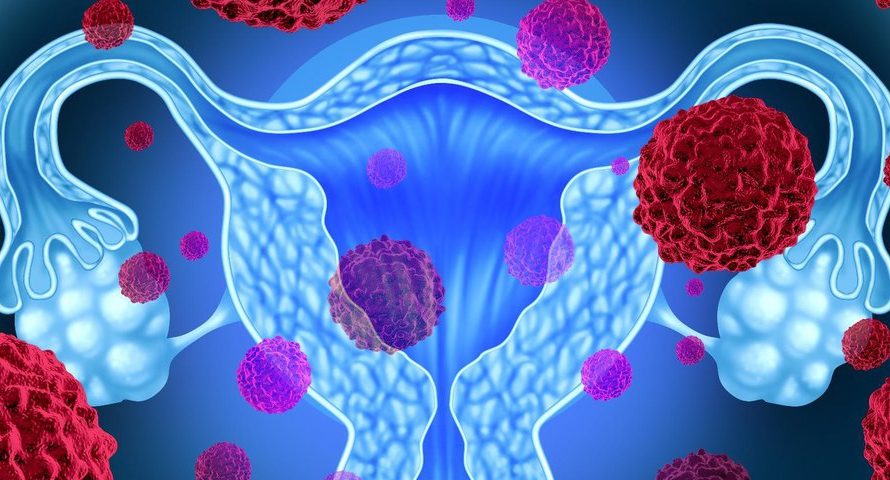 Рак Яичников