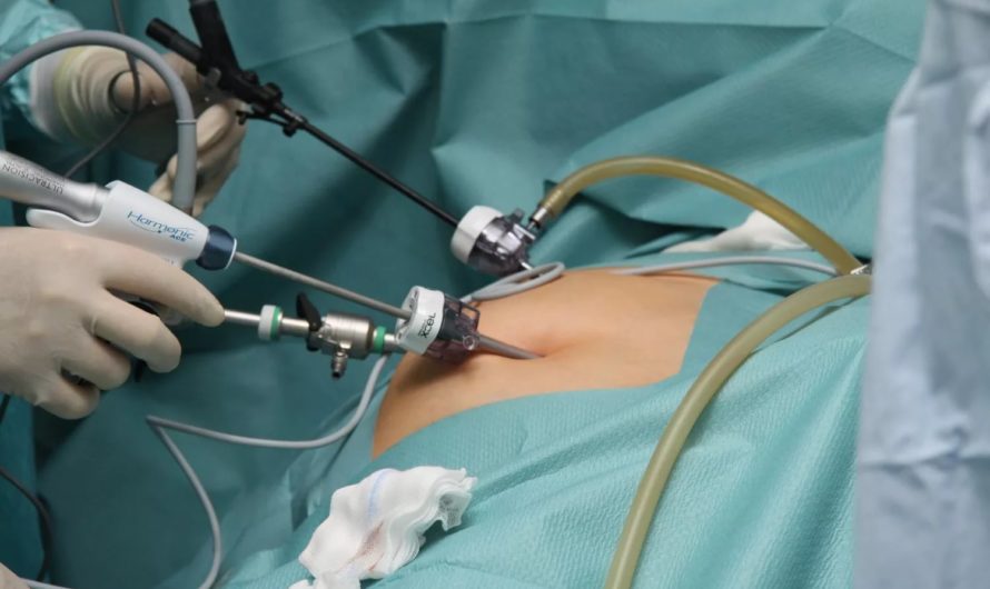 Удаление кисты яичника