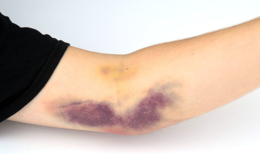 Сонник: Ушиб