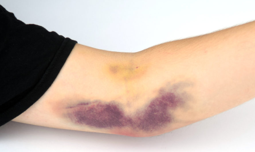 Сонник Синяк