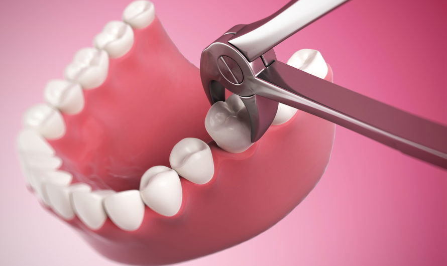 Сонник: вырвать зуб