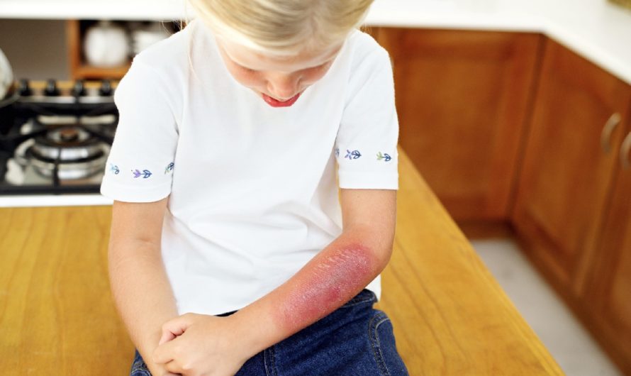 Сонник Ошпариться